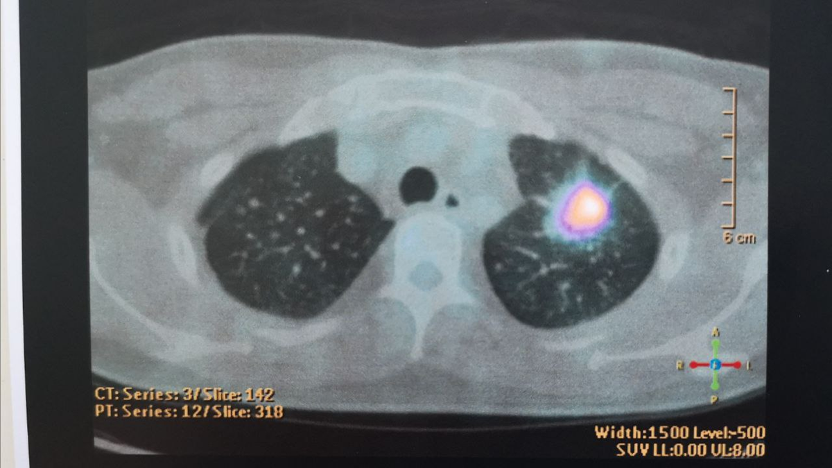 掃描下的肺，一堆擴散的小白點和右邊可見約3公分的異物